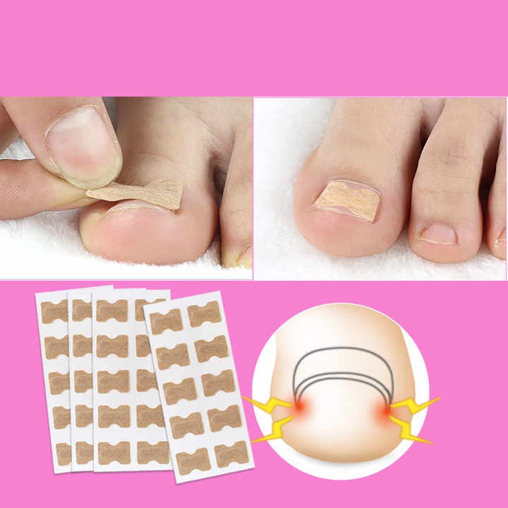 UÑIPATCH - PARCHES PARA HONGOS Y UÑAS ENCARNADAS 🩹